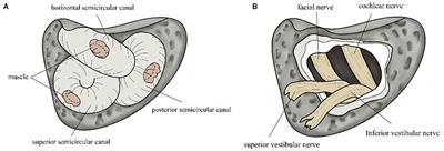 Changes of Vestibular Symptoms in Menière's Disease After Triple Semicircular Canal Occlusion: A Long-Term Follow-Up Study